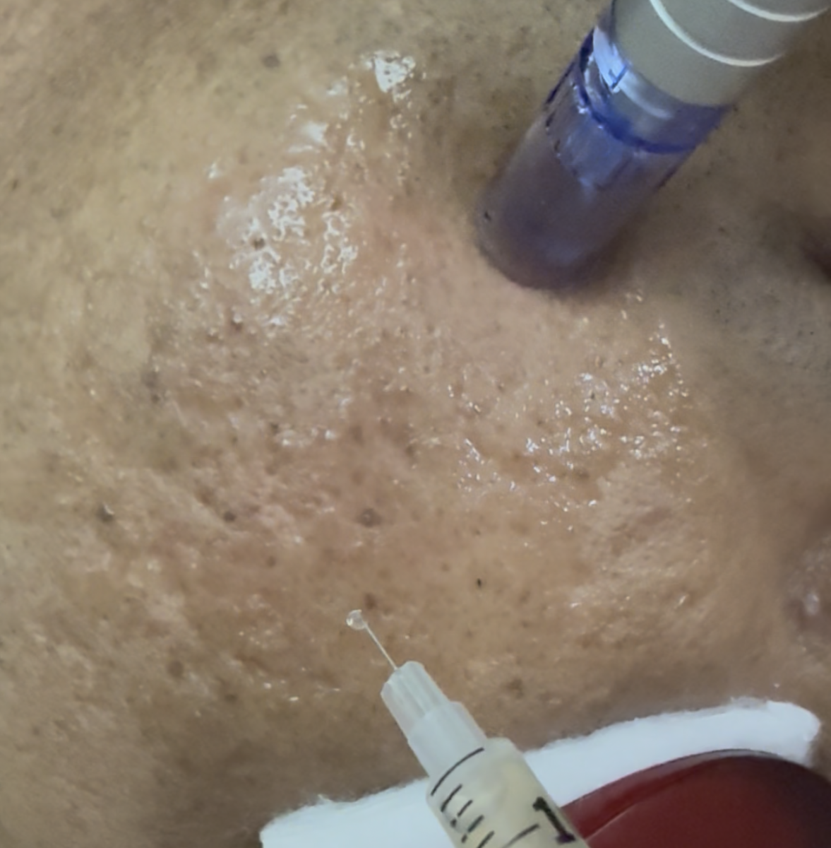 PRP Facial with Microneedling