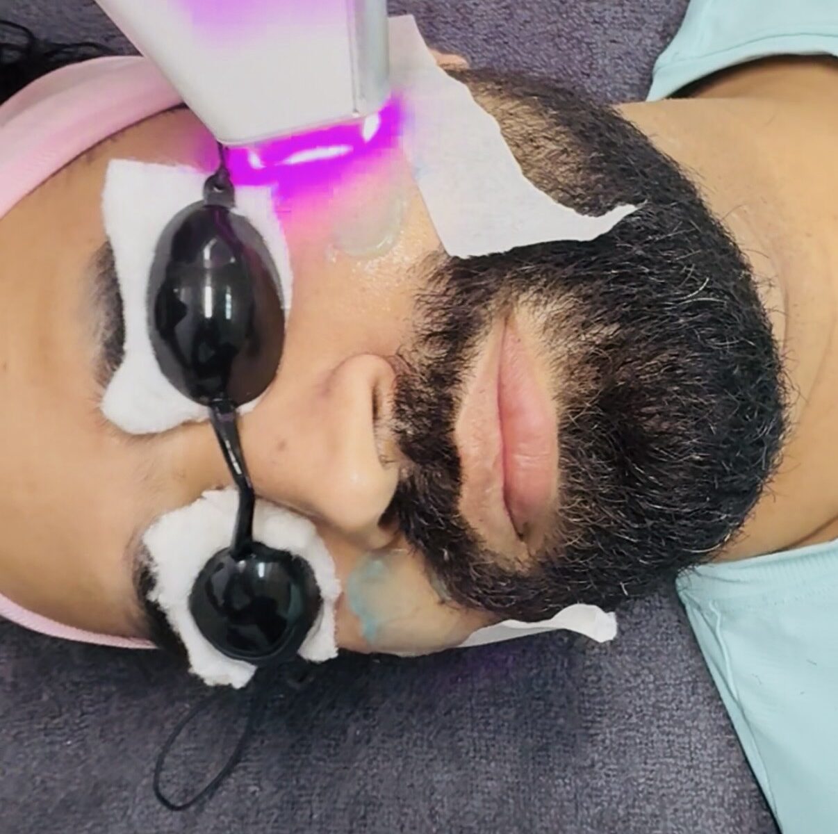 Carbon Laser Peel