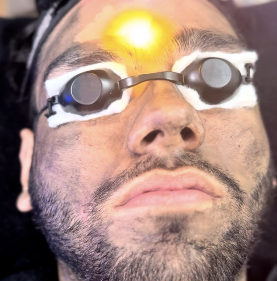 Carbon Laser Peel (Hollywood Facial)1